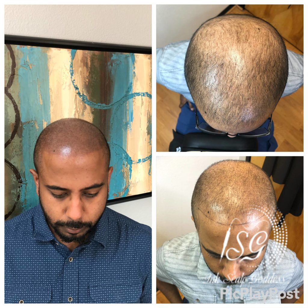 Natural Hairlines, Real Results: Exploring Scalp Micropigmentation